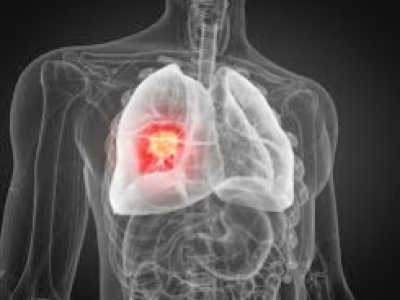 Cancer du poumon / cigarette électronique : Les données scientifiques