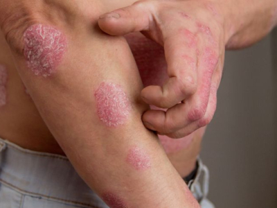 Psoriasis et CBD : le cannabidiol peut-il aider à apaiser les symptômes ?
